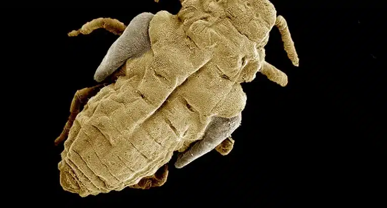 Head lice treatment explained step by step. Memorial Family Practice in Artesia, NM is here when OTC options aren’t working. Call 575-746-3119.